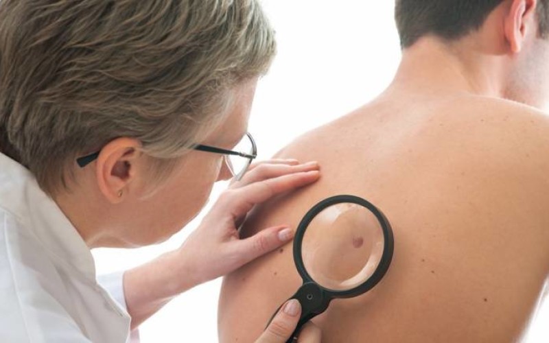 Gonidio_Melanoma