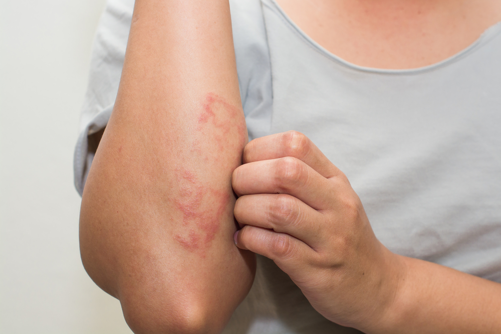 C-Derm Kρέμα Mουρουνέλαιου 50% - Αποτελεσματική και Ασφαλής στην Ψωρίαση κατά Πλάκας   