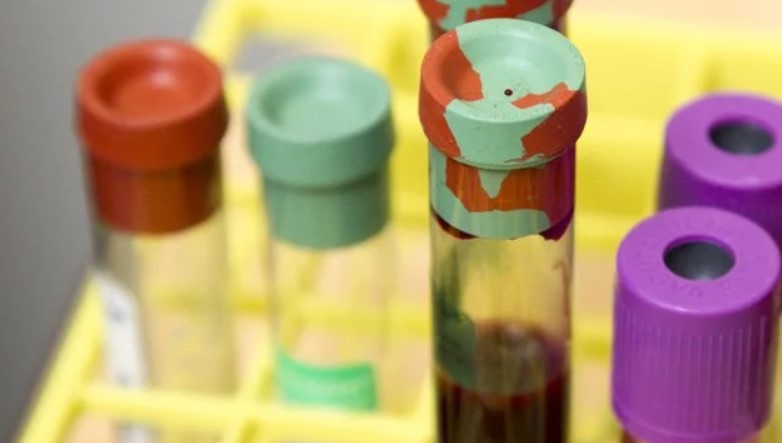 Η λοίμωξη COVID-19 έχει σημαντική επίδραση στο αιμοποιητικό σύστημα και την αιμόσταση. Η λοίμωξη COVID-19 έχει σημαντική επίδραση στο αιμοποιητικό σύστημα και την αιμόσταση.