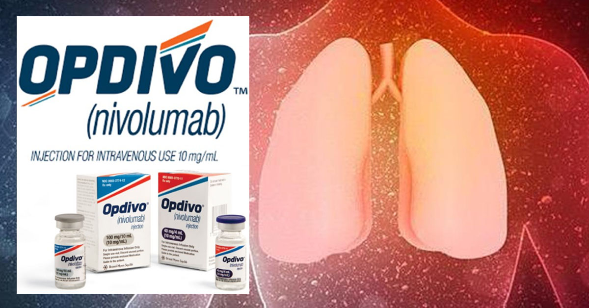 Έγκριση Συνδυασμού Nivolumab με Χημειοθεραπεία με Βάση την Πλατίνα για τον Χειρουργίσιμο Καρκίνο του Πνεύμονα Έγκριση Συνδυασμού Nivolumab με Χημειοθεραπεία με Βάση την Πλατίνα για τον Χειρουργίσιμο Καρκίνο του Πνεύμονα